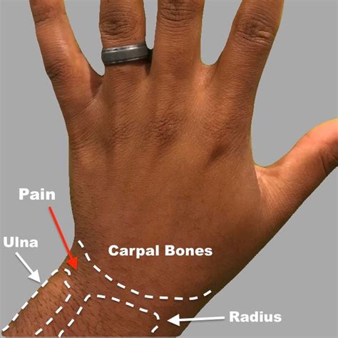 torn cartilage in wrist symptoms